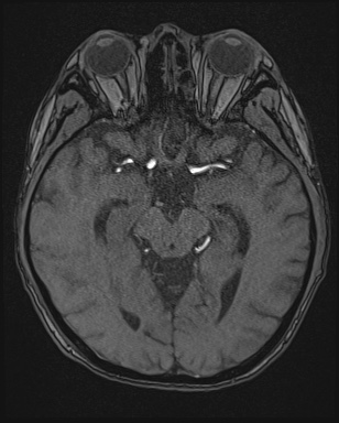 Cerebral embolic infarcts (embolic shower) (Radiopaedia 72391-82921 Axial MRA 67).jpg