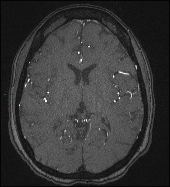 Cerebral fat embolism (Radiopaedia 35022-36525 Axial TOF 114).jpg
