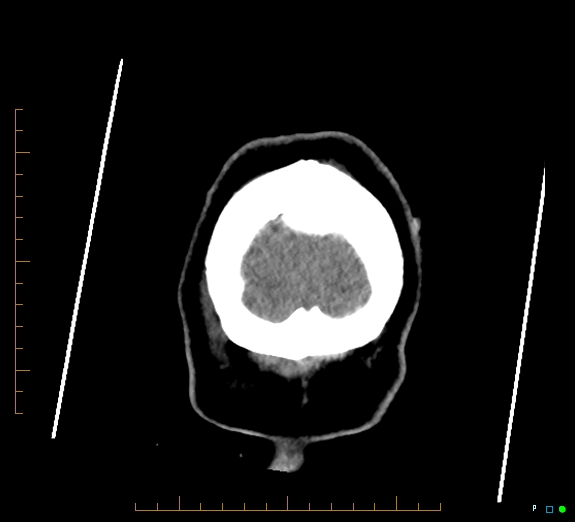 Cerebral fat embolism (Radiopaedia 85521-101220 Coronal non-contrast 60).jpg