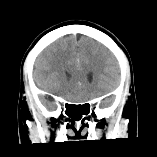 Cerebral hemorrhage secondary to arteriovenous malformation (Radiopaedia 33497-34561 C 22).png