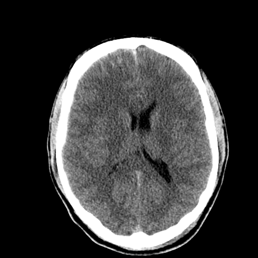 File:Cerebral hemorrhagic contusions- temporal evolution (Radiopaedia 40224-42753 Axial non-contrast 19).png
