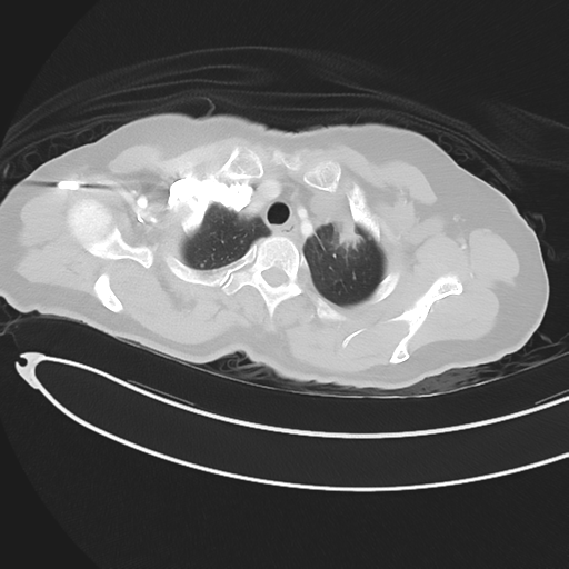 Cerebral metastases (Radiopaedia 33041-34055 Axial lung window 10).png