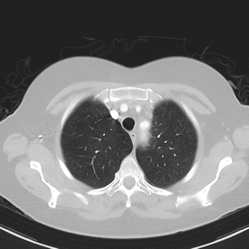 File:Cerebral metastasis mimicking glioblastoma (Radiopaedia 69155-78938 Axial lung window 8).png