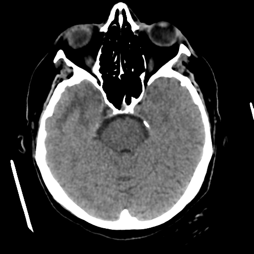 File:Cerebral metastasis to basal ganglia (Radiopaedia 81568-95412 Axial non-contrast 23).png