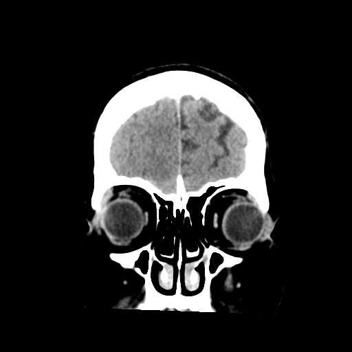 Cerebral metastasis to basal ganglia (Radiopaedia 81568-95412 Coronal C+ delayed 11).png