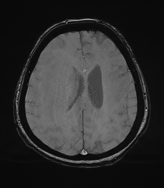File:Cerebral metastasis to basal ganglia (Radiopaedia 81568-95413 Axial SWI magnitude 60).png