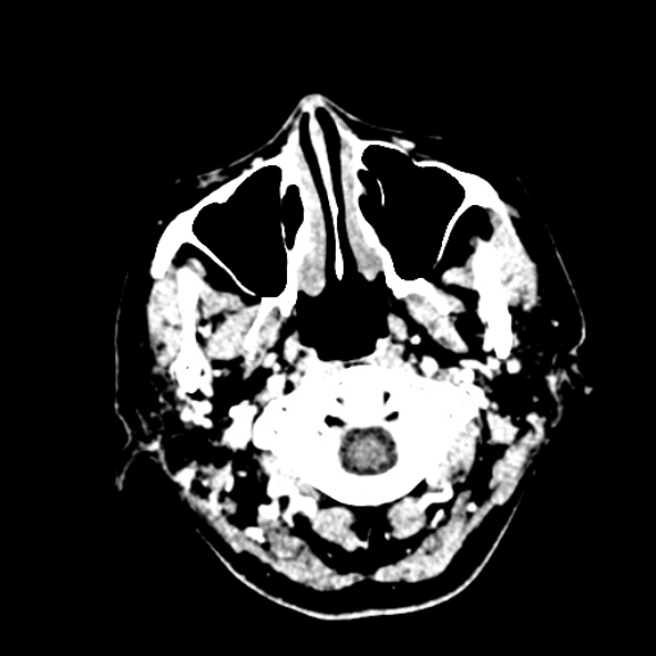 Cerebral ring enhancing lesions - cerebral metastases (Radiopaedia 44922-48818 B 8).jpg