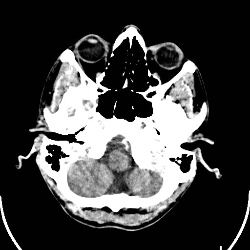 File:Cerebral toxoplasmosis (Radiopaedia 43956-47460 Axial C+ delayed 1).jpg