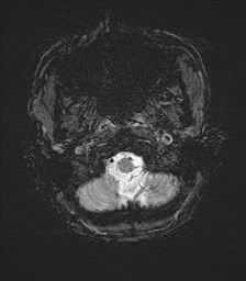 File:Cerebral toxoplasmosis (Radiopaedia 43956-47461 Axial SWI 2).jpg