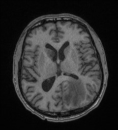 Cerebral toxoplasmosis (Radiopaedia 43956-47461 Axial T1 42).jpg