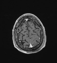 Cerebral toxoplasmosis (Radiopaedia 43956-47461 Axial T1 C+ 68).jpg