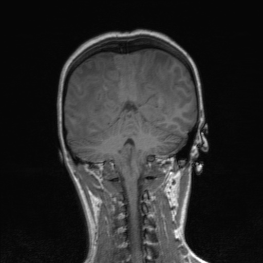 Cerebral tuberculosis with dural sinus invasion (Radiopaedia 60353-68090 Coronal T1 132).jpg