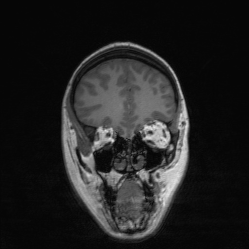 Cerebral tuberculosis with dural sinus invasion (Radiopaedia 60353-68090 Coronal T1 50).jpg