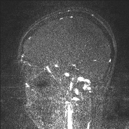 Cerebral tuberculosis with dural sinus invasion (Radiopaedia 60353-68090 Sagittal MRV 98).jpg