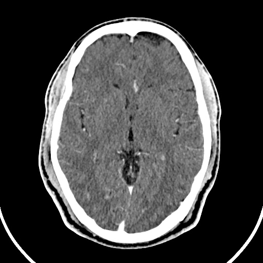 File:Cerebral venous angioma (Radiopaedia 69959-79977 B 42).jpg