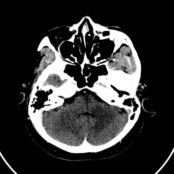 Cerebral venous hemorrhagic infarct from venous sinus thrombosis (Radiopaedia 55433-61883 Axial C+ delayed 116).jpg