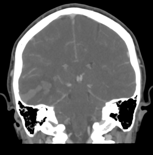 Cerebral venous hemorrhagic infarction (Radiopaedia 38461-40550 Coronal MIP VENOGRAM 37).png