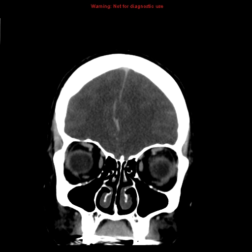 Cerebral venous infarction (Radiopaedia 12404-20735 B 16).jpg