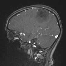 Cerebral venous infarction - hemorrhagic (Radiopaedia 81625-95505 Sagittal MRV 28).jpg