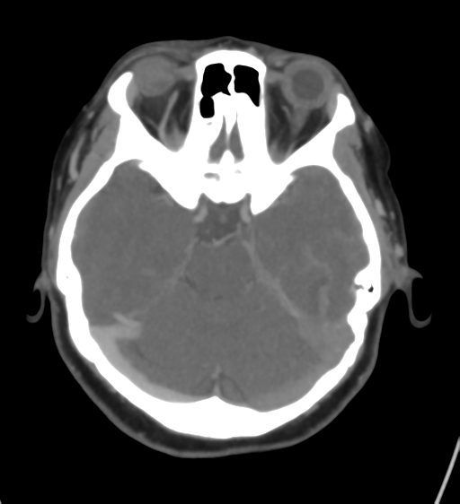 File:Cerebral venous infarction due to transverse sinus thrombosis (Radiopaedia 34688-36120 Axial CT venogram 19).png