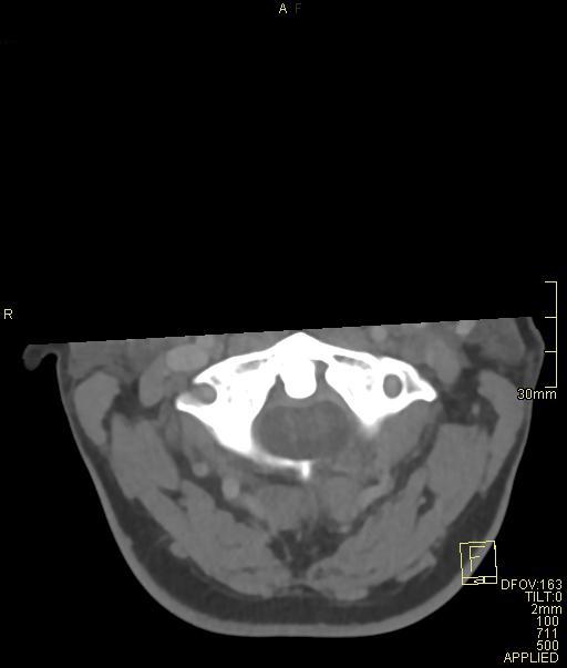 Cerebral venous sinus thrombosis (Radiopaedia 91329-108965 Axial venogram 3).jpg