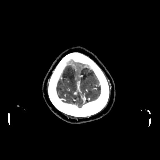 File:Cerebral venous throbmosis - hemorrhagic venous infarction (Radiopaedia 87318-103613 Axial CT venogram 38).jpg
