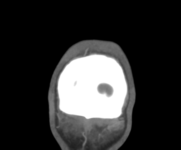 Cerebral venous thrombosis (Radiopaedia 38392-40467 Coronal CTA-Venogram 61).png