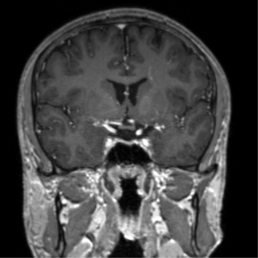 Cerebral venous thrombosis (Radiopaedia 38392-40469 Coronal T1 C+ 53).png