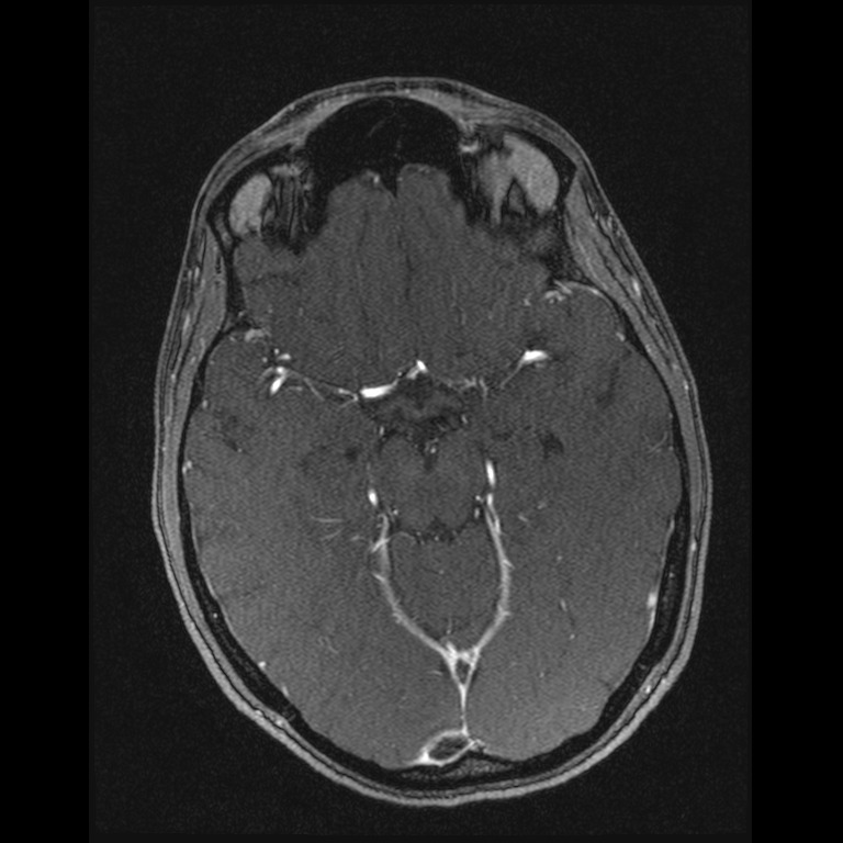 Cerebral venous thrombosis (Radiopaedia 45678-49854 Axial MRV 28).jpg