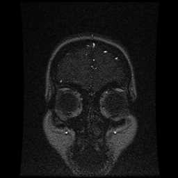 Cerebral venous thrombosis - ulcerative colitis (Radiopaedia 66049-75219 Coronal MRV 102).jpg