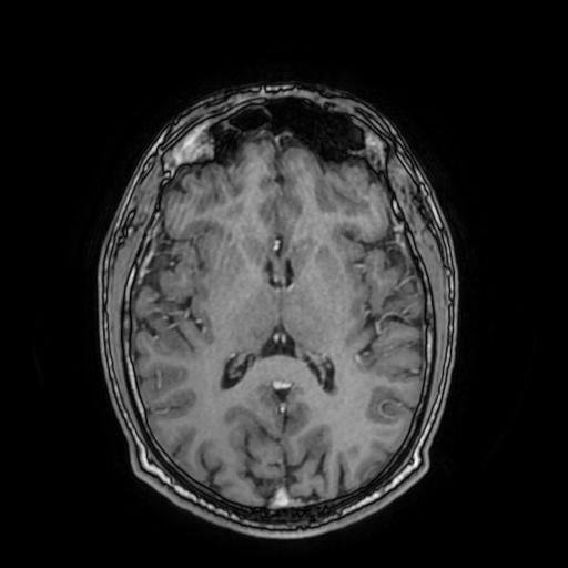 File:Cerebral venous thrombosis with secondary intracranial hypertension (Radiopaedia 89842-106957 Axial T1 C+ 100).jpg