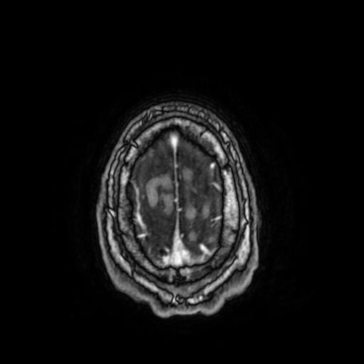 File:Cerebral venous thrombosis with secondary intracranial hypertension (Radiopaedia 89842-106957 Axial T1 C+ 155).jpg