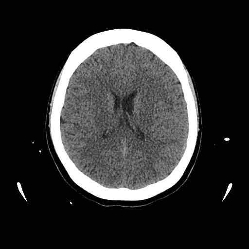 Cerebral venous thrombosis with venous hemorrhagic infarct (Radiopaedia 90354-107660 Axial non-contrast 31).jpg