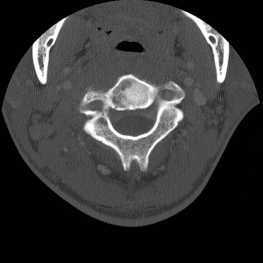 Cervical Pott disease (Radiopaedia 20374-20286 Axial bone window 41).jpg