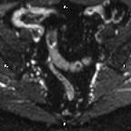 Cervical adenocarcinoma (Radiopaedia 65011-73985 Axial DWI 64).jpg