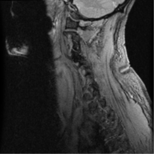 File:Cervical canal stenosis with cord compression (Radiopaedia 34114-35374 D 17).png