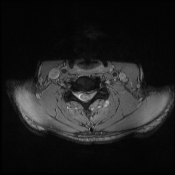 File:Cervical disc extrusion (Radiopaedia 53950-60077 Axial T2 19).jpg