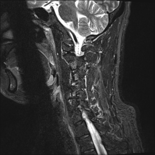 File:Cervical disc extrusion (Radiopaedia 53950-60077 Sagittal STIR 13).jpg