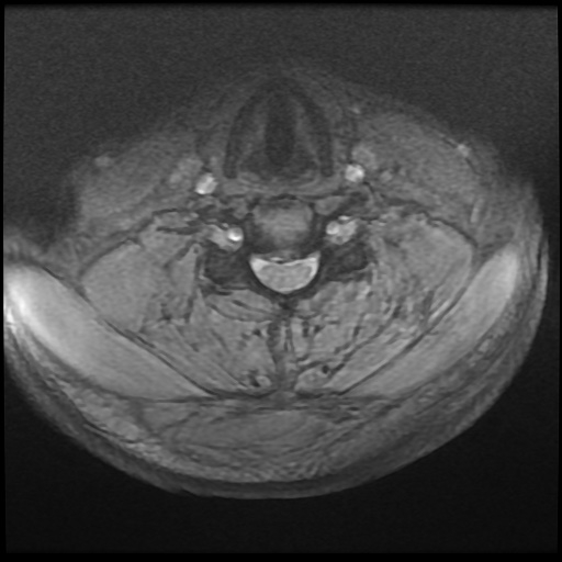 Cervical disc extrusion (Radiopaedia 59074-66364 F 33).jpg