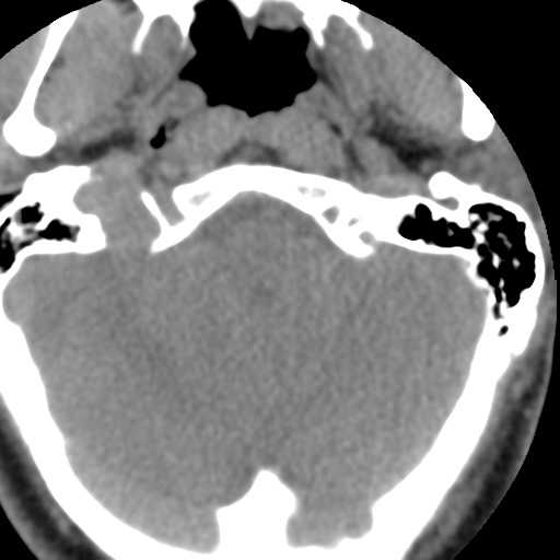 Cervical schwannoma (Radiopaedia 57979-64974 Axial non-contrast 8).png