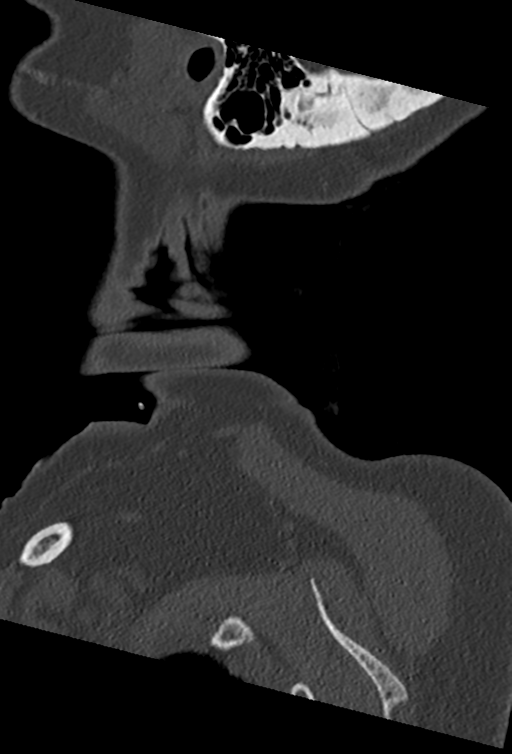 Cervical spine ACDF loosening (Radiopaedia 48998-54070 Sagittal bone window 4).png
