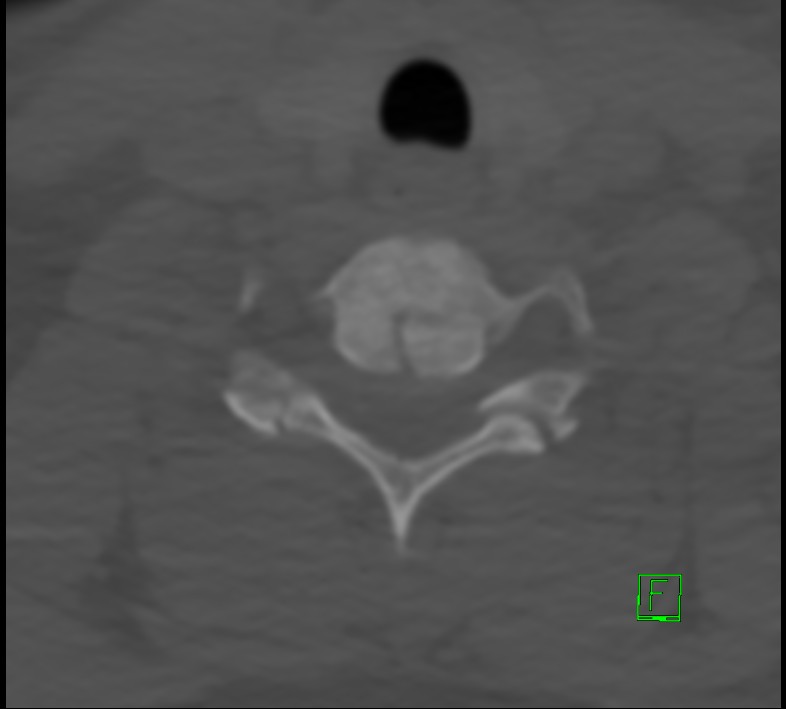 Cervical spine fracture - hyperflexion injury (Radiopaedia 66184-75364 Axial bone window 41).jpg