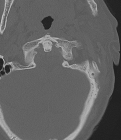 Cervical spine fracture in the setting of ankylosis (Radiopaedia 37038-38715 Axial bone window 12).png
