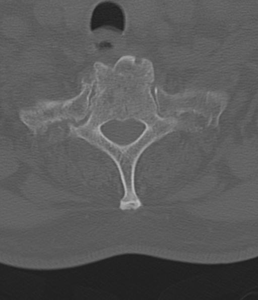 File:Cervical spine fracture in the setting of ankylosis (Radiopaedia 37038-38715 Axial bone window 51).png