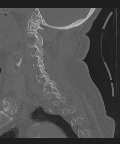 Cervical spine fracture in the setting of ankylosis (Radiopaedia 37038-38715 Sagittal bone window 28).png