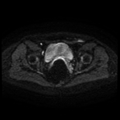 File:Cesarian section scar endometriosis (Radiopaedia 66520-75799 Axial DWI 41).jpg