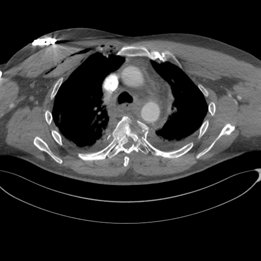 File:Chest multitrauma - aortic injury (Radiopaedia 34708-36147 A 103).png
