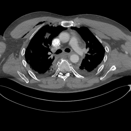 File:Chest multitrauma - aortic injury (Radiopaedia 34708-36147 A 120).png