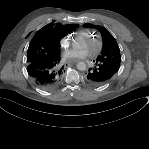 File:Chest multitrauma - aortic injury (Radiopaedia 34708-36147 A 172).png