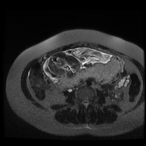 Chiari II malformation - fetal MRI (Radiopaedia 68099-77581 Axial T2-SSFSE 8).jpg